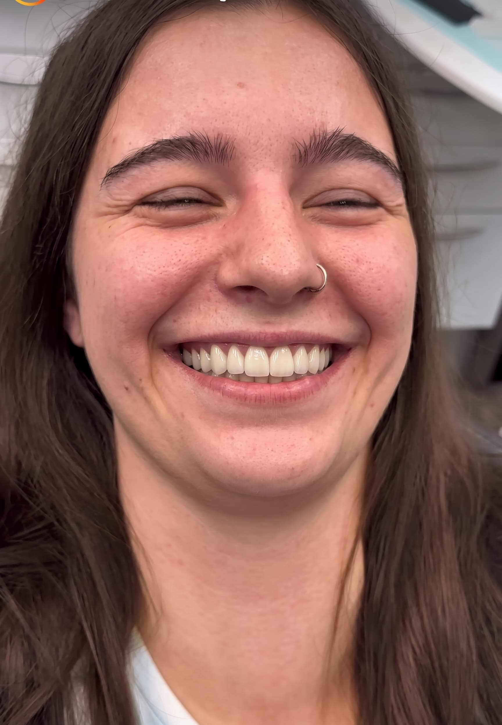 SmileUp AI estetik gülüş simülasyonu örneği